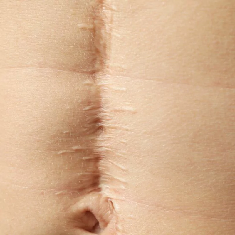 tratament-cicatrici-cheloide-pret
