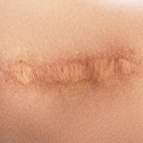 cicatrici-cheloide