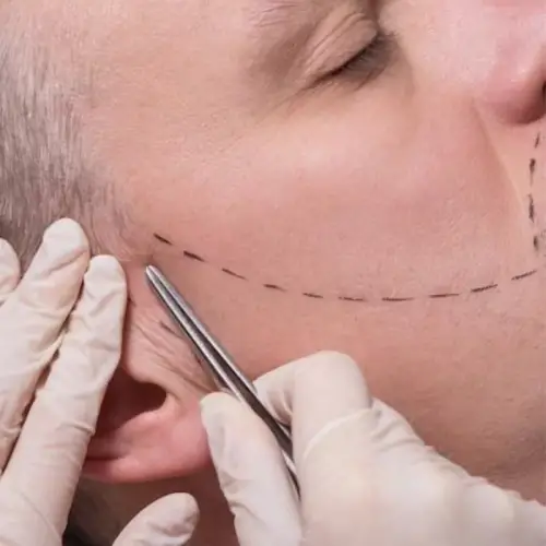 transplant-barba-pret transplant-barba-pret